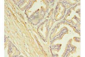 Immunohistochemistry of paraffin-embedded human prostate cancer using ABIN7146360 at dilution of 1:100 (SLC25A25 anticorps  (AA 1-189))