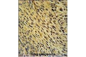 CCDC62 Antibody (C-term) (ABIN651350 and ABIN2840196) immunohistochemistry analysis in formalin fixed and paraffin embedded human lung carcinoma followed by peroxidase conjugation of the secondary antibody and DAB staining. (CCDC62 anticorps  (C-Term))