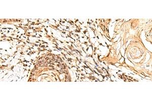 Immunohistochemistry of paraffin-embedded Human esophagus cancer tissue using RETREG1 Polyclonal Antibody at dilution of 1:60(x200) (FAM134B anticorps)