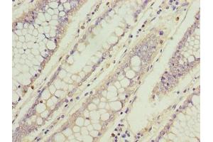 Immunohistochemistry of paraffin-embedded human colon cancer using ABIN7173742 at dilution of 1:100