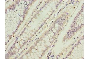 Immunohistochemistry of paraffin-embedded human colon cancer using ABIN7173742 at dilution of 1:100 (TBCC anticorps  (AA 2-346))