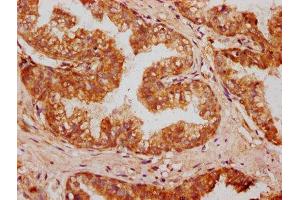 IHC image of ABIN7162317 diluted at 1:400 and staining in paraffin-embedded human prostate cancer performed on a Leica BondTM system. (Osteomodulin anticorps  (AA 339-411))