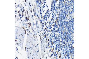 Immunohistochemistry of paraffin-embedded human colon carcinoma using STK19 Rabbit pAb (ABIN6132689, ABIN6148598, ABIN6148600 and ABIN6217358) at dilution of 1:100 (40x lens).