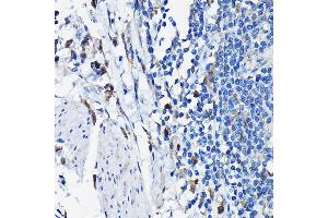 Immunohistochemistry of paraffin-embedded human colon carcinoma using STK19 Rabbit pAb (ABIN6132689, ABIN6148598, ABIN6148600 and ABIN6217358) at dilution of 1:100 (40x lens). (STK19 anticorps  (AA 75-364))