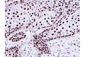 AP19041PU-N hnRNP-C1/C2 antibody staining of Paraffin-Embedded Cal27 xenograft at 1/100 dilution.