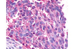 Anti-GPR17 antibody IHC of human Ovary, Carcinoma. (GPR17 anticorps  (Cytoplasmic Domain))