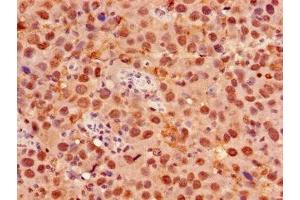 Immunohistochemistry of paraffin-embedded human pancreatic cancer using ABIN7153058 at dilution of 1:100