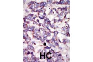 Formalin-fixed and paraffin-embedded human hepatocellular carcinoma tissue reacted with PDK2 polyclonal antibody  , which was peroxidase-conjugated to the secondary antibody, followed by DAB staining . (PDK2 anticorps  (AA 378-407))