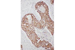 Anti-TNFAIP8L3 antibody, IHC(P) IHC(P): Human Mammary Cancer Tissue (TNFAIP8L3 anticorps  (C-Term))