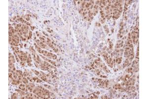 IHC-P Image Immunohistochemical analysis of paraffin-embedded DLD-1 xenograft , using SSA1, antibody at 1:500 dilution. (TRIM21 anticorps)