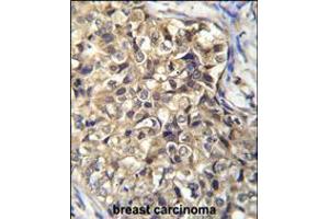 KLHL35 Antibody immunohistochemistry analysis in formalin fixed and paraffin embedded human breast carcinoma followed by peroxidase conjugation of the secondary antibody and DAB staining. (KLHL35 anticorps  (C-Term))