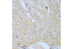 Immunohistochemistry of paraffin-embedded human liver cancer using CEACAM7 antibody at dilution of 1:100 (40x lens). (CEACAM7 anticorps)