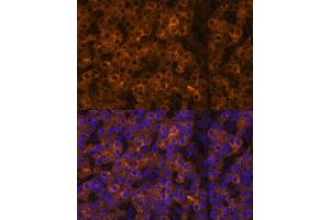 Immunofluorescence analysis of human liver cancer using TTR Polyclonal Antibody (ABIN3021473, ABIN3021474, ABIN3021475 and ABIN6215107) at dilution of 1:100 (40x lens). (TTR anticorps  (AA 21-147))