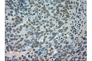 Immunohistochemical staining of paraffin-embedded Adenocarcinoma of colon tissue using anti-CTAG1Bmouse monoclonal antibody.