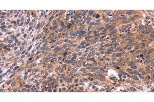 Immunohistochemistry of paraffin-embedded Human cervical cancer tissue using CRK Polyclonal Antibody at dilution 1:40 (Crk anticorps)