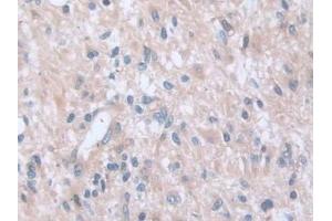 Detection of CAP2 in Human Glioma Tissue using Polyclonal Antibody to Adenylyl Cyclase Associated Protein 2 (CAP2)