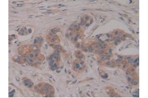 IHC-P analysis of Human Breast Cancer Tissue, with DAB staining. (PSG1 anticorps  (AA 202-401))