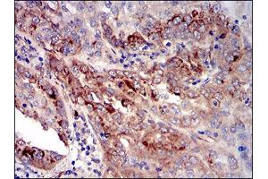 Immunohistochemical analysis of paraffin-embedded cervical cancer tissues using CK5 mouse mAb with DAB staining.