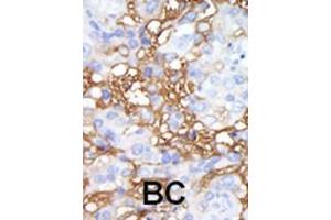 Formalin-fixed and paraffin-embedded human cancer tissue reacted with the primary antibody, which was peroxidase-conjugated to the secondary antibody, followed by DAB staining. (MAP4K1 anticorps  (C-Term))