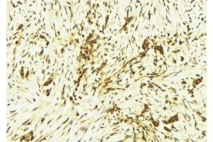 ABIN6269245 at 1/100 staining Human breast cancer tissue by IHC-P. (STAT1 anticorps)