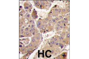 Formalin-fixed and paraffin-embedded human hepatocarcinoma tissue reacted with PIK3R3 antibody , which was peroxidase-conjugated to the secondary antibody, followed by DAB staining. (PIK3R3 anticorps  (C-Term))