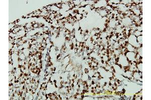 Immunoperoxidase of monoclonal antibody to CDKN1B on formalin-fixed paraffin-embedded human ovary, clear cell carcinoma tissue. (CDKN1B anticorps  (AA 1-198))