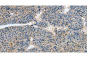 Immunohistochemistry of paraffin-embedded Human liver cancer tissue using ATP4B Polyclonal Antibody at dilution 1:40 (ATP4b anticorps)