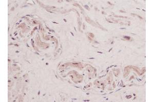 Formalin-Fixed, Paraffin-Embedded Human Sections prostate stained with TSLP Antibody Cat. (Thymic Stromal Lymphopoietin anticorps)