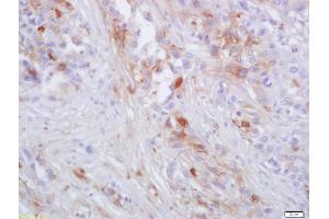 Formalin-fixed and paraffin embedded human lung carcinoma labeled with Anti-CCR-2 Polyclonal Antibody, Unconjugated (ABIN670146) at 1:200 followed by conjugation to the secondary antibody and DAB staining (CCR2 anticorps)