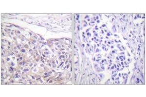 Immunohistochemistry analysis of paraffin-embedded human breast carcinoma tissue using p90 RSK (Phospho-Thr573) antibody. (RPS6KA3 anticorps  (pThr573))