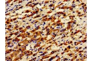 Immunohistochemistry of paraffin-embedded human liver cancer using ABIN7143372 at dilution of 1:100 (GPR124 anticorps  (AA 1069-1338))