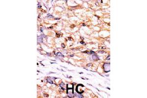 Formalin-fixed and paraffin-embedded human hepatocellular carcinoma tissue reacted with CTDSP1 polyclonal antibody  , which was peroxidase-conjugated to the secondary antibody, followed by DAB staining. (CTDSP1 anticorps  (C-Term))