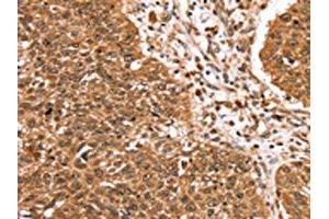 The image on the left is immunohistochemistry of paraffin-embedded Human lung cancer tissue using ABIN7192748(TCEB3B Antibody) at dilution 1/25, on the right is treated with synthetic peptide. (TCEB3B anticorps)