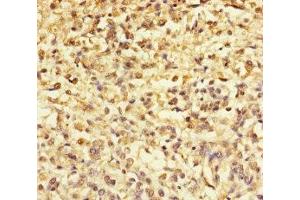 Immunohistochemistry of paraffin-embedded human melanoma using ABIN7172299 at dilution of 1:100