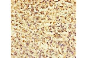Immunohistochemistry of paraffin-embedded human melanoma using ABIN7172299 at dilution of 1:100 (TMEFF2 anticorps  (AA 41-320))