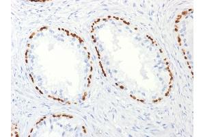 Formalin-fixed, paraffin-embedded human Prostate Carcinoma stained with p63 Mouse Monoclonal Antibody (TP63/2427). (p63 anticorps)