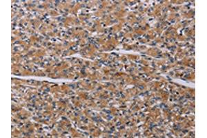 The image on the left is immunohistochemistry of paraffin-embedded Human prostate cancer tissue using ABIN7191790(PARP4 Antibody) at dilution 1/20, on the right is treated with synthetic peptide. (PARP4 anticorps)
