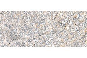 Immunohistochemistry of paraffin-embedded Human tonsil tissue using GSKIP Polyclonal Antibody at dilution of 1:55(x200)