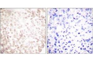 Immunohistochemistry analysis of paraffin-embedded human lung carcinoma tissue, using XRCC1 Antibody. (RCC1 anticorps  (AA 517-566))