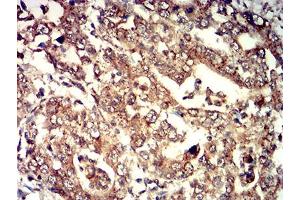 Immunohistochemical analysis of paraffin-embedded stomach cancer tissues using ELANE mouse mAb with DAB staining.