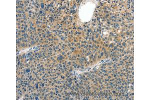 Immunohistochemistry of Human thyroid cancer using CRLF2 Polyclonal Antibody at dilution of 1:60 (CRLF2 anticorps)