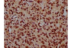 IHC image of ABIN7162006 diluted at 1:300 and staining in paraffin-embedded human glioma performed on a Leica BondTM system. (TMEM48 anticorps  (AA 385-517))
