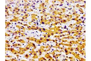 Immunohistochemistry of paraffin-embedded human liver cancer using ABIN7164629 at dilution of 1:100 (USP9X anticorps  (C-Term))