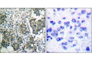 Immunohistochemistry analysis of paraffin-embedded human breast carcinoma tissue, using Keratin 8 (Ab-73) Antibody. (KRT8 anticorps  (AA 41-90))