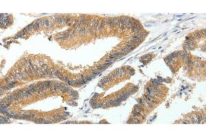 Immunohistochemistry of paraffin-embedded Human colon cancer tissue using MDK Polyclonal Antibody at dilution 1:60 (Midkine anticorps)