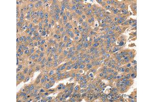 Immunohistochemistry of Human ovarian cancer using IRF1 Polyclonal Antibody at dilution of 1:40 (IRF1 anticorps)