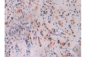 IHC-P analysis of Human Prostate Gland Cancer Tissue, with DAB staining. (Butyrylcholinesterase anticorps  (AA 29-150))