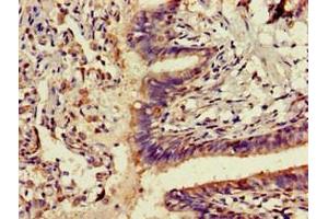 Immunohistochemistry of paraffin-embedded human lung cancer using ABIN7143291 at dilution of 1:100