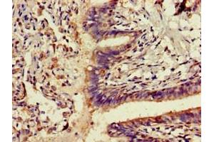 Immunohistochemistry of paraffin-embedded human lung cancer using ABIN7143291 at dilution of 1:100 (ADK anticorps  (AA 18-256))
