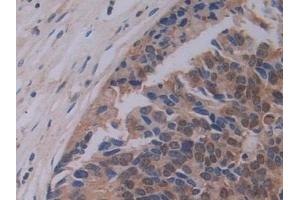 Detection of PEBP1 in Human Prostate cancer Tissue using Polyclonal Antibody to Phosphatidylethanolamine Binding Protein 1 (PEBP1) (PEBP1 anticorps  (AA 2-187))